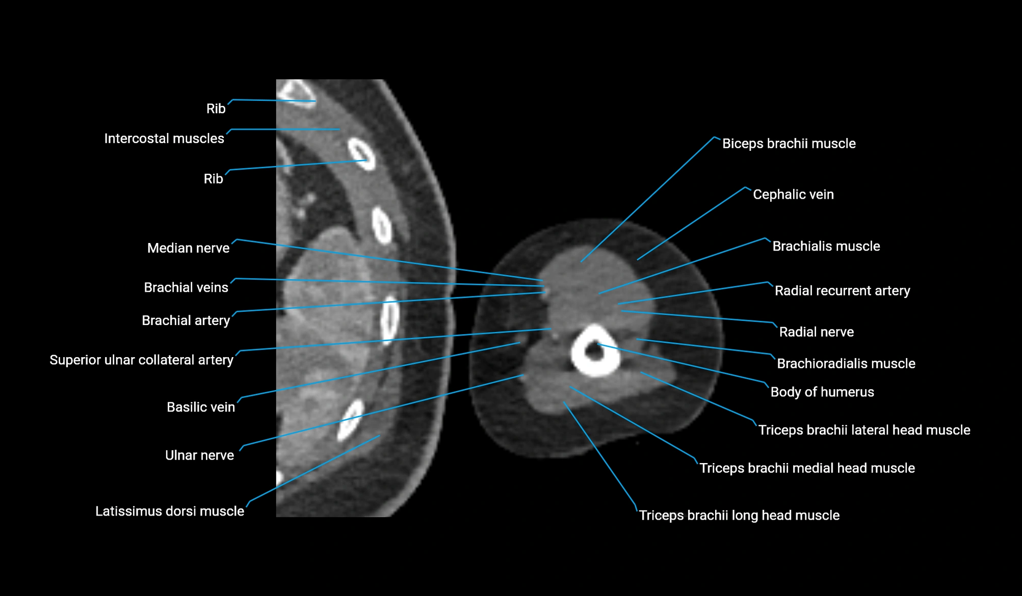 CT upper arm axial  cross sectional anatomy labelled radiology image -00310.webp